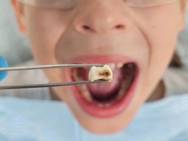 Best Dental Abscess Treatment in Jackson, MO